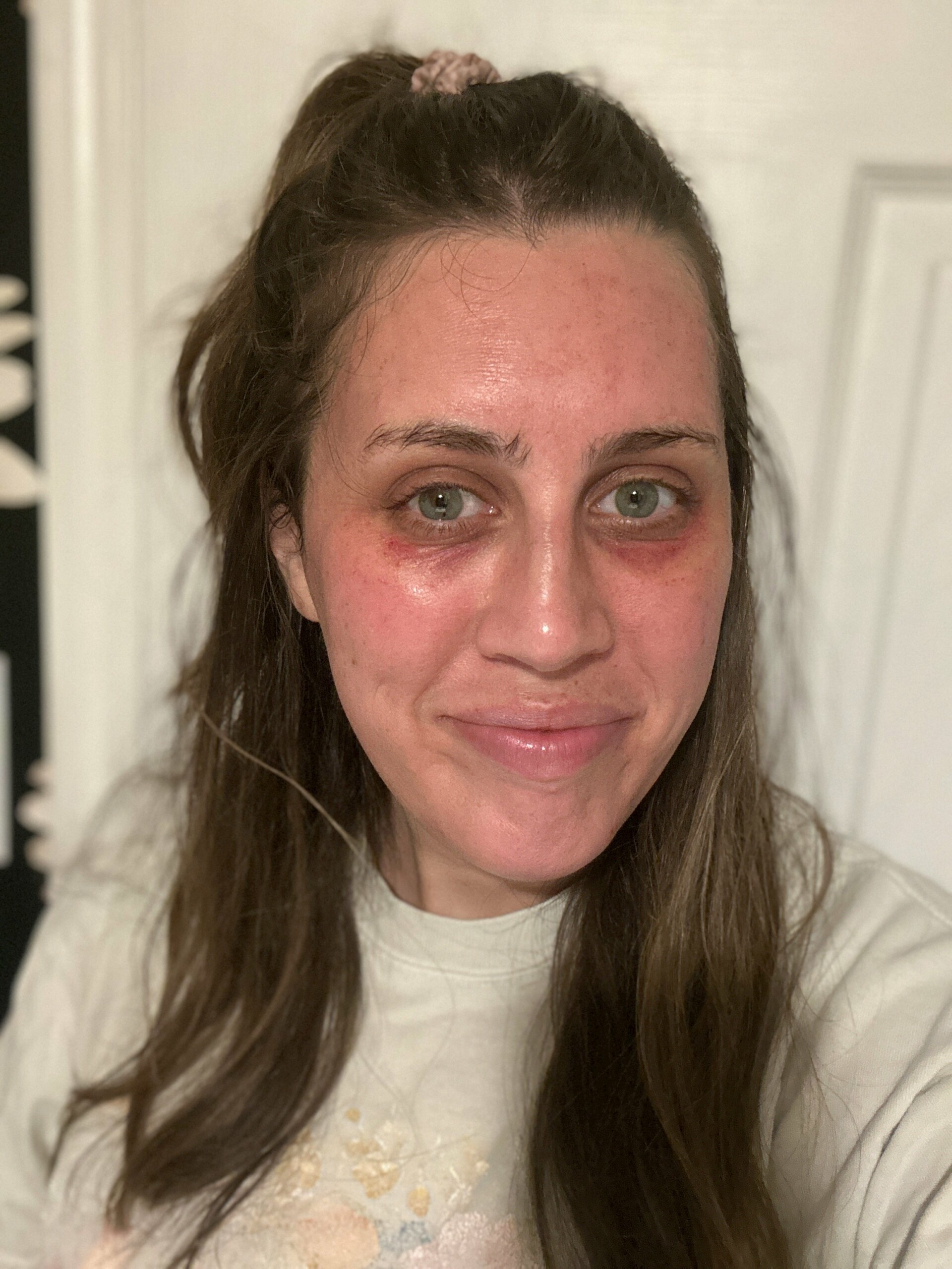 i-tried-professional-microneedling,-&-my-dark-circles-have-never-looked-better